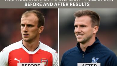 Rob Holding hair transplant